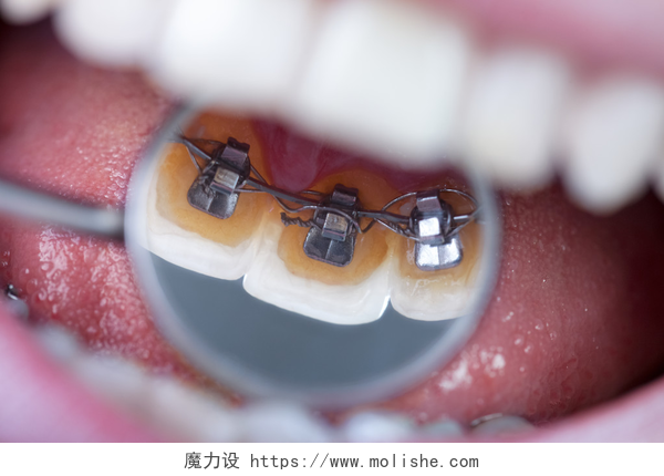 镜子里显示的牙齿牙科镜像显示大括号